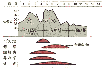 はしかの経過